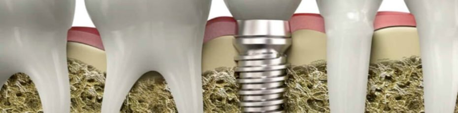 the cost of dental implants in los angeles