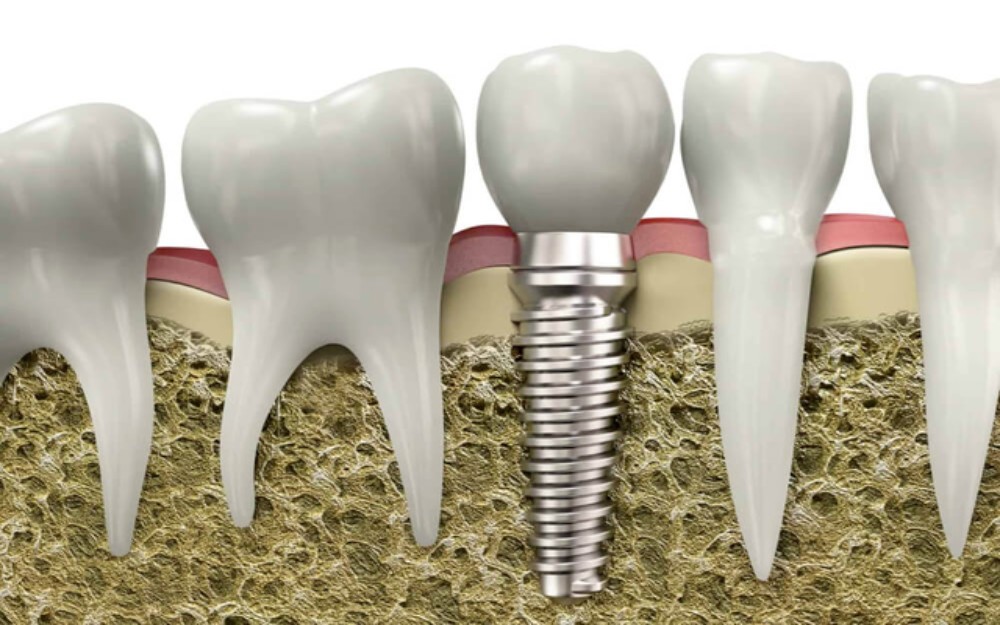 the cost of dental implants in los angeles