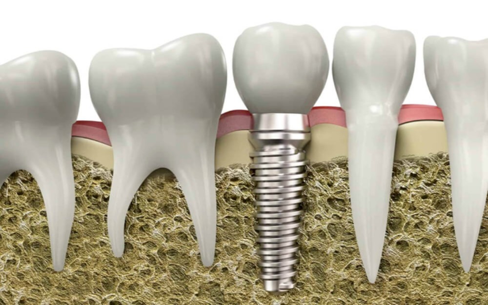 The Cost Of Dental Implants In Los Angeles