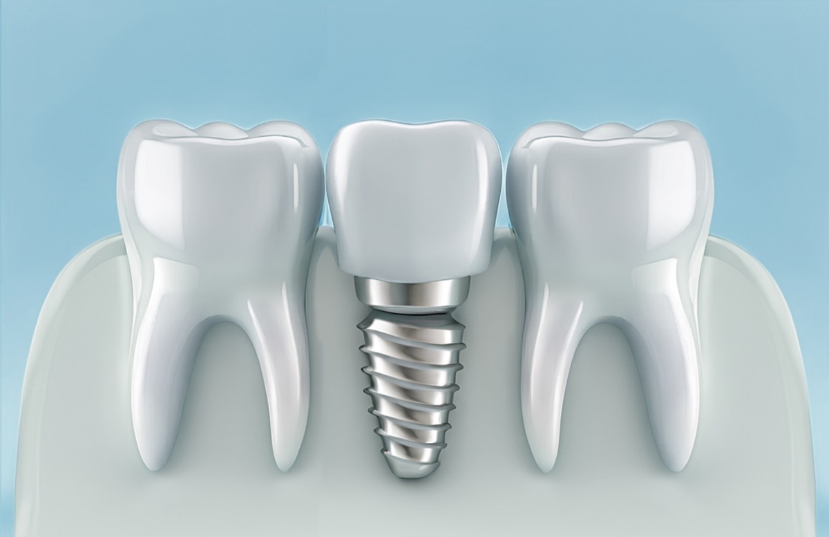 are dental implants worth it